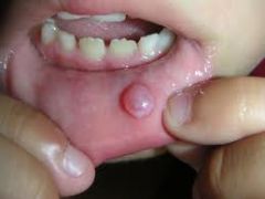 Buccal Mucosa  & Inside of lower lip