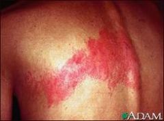 Shingles	
Adults and the elderly 
(but can see in younger adults on occasion)