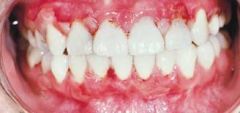 Oral lesions are usually seen first.  
Scarring   
**Bulla forms in subepithelia areas and Nikolsky sign is common.**