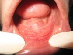 Epulis Fissuratum  (Dentures pinching the tissue)  
May be a longer strip of tissue in this case.