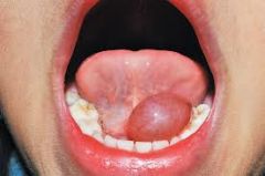 A LARGE swelling of the sublingual  or submandibular salivary glands on the floor of the mouth.  
(Same as a mucocele but much larger)