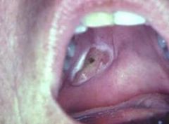 minor salivary gland necrosis related to (R/T) trauma