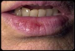 Actinic Keratosis!  
(Often seen in the lips where someone is chronically burning them.)
