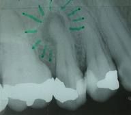 What is the only way to tell a periapical granuloma from a radicular cyst?