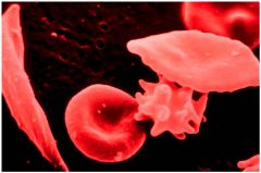 Sickle cell --- less water soluble --- brittle  ---- treatment