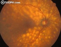 In this dark fundus the multiple, usually subtle lesions that affect choroid and outer retina, are well visible.