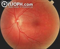 41 years, female, complaining of photopsia for one week, with visual acuity of 20/20. Funduscopy revealed spots difficult to define and gray-white lesions in the posterior pole, mainly temporal to the fovea.