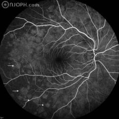 41 years, female, complaining of photopsia for one week, with visual acuity of 20/20. Fluorescein angiogram (FA) showed early hyperfluorescent dots with late staining.