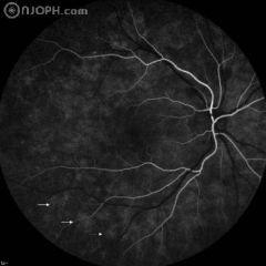 41 years, female, complaining of photopsia for one week, with visual acuity of 20/20. Funduscopy revealed spots difficult to define and gray-white lesions in the posterior pole, mainly temporal to the fovea. Early fluorescein angiogram (FA) showed early h
