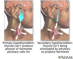 Secondary hypothyroidism