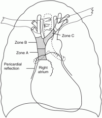 Cardiac tamponade
- Hx
dyspnoea, orthopnoea, PND
- Ex
hypoxia, tachypnoea, tachycardia, muffled HS
raised JVP, kussmaul's sign, pulsus paradoxus
LVF, leg oedema
- Ix
CXR (large globular heart, LVF)
Echo (pericardial effusion, RA collapse)
ECG (l