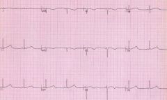 (2011-A) Question 14 (a) Describe the abnormality on this electrocardiogram. (30%) (b) What are the implications of this abnormality for anaesthesia? (70%)