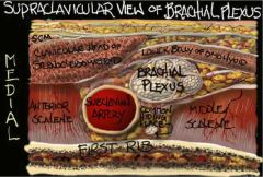 As pic shows, supraclavicular block targets the trunks of the brachial plexus (although as this pic shows, ulnar nerve sometimes comes of early and is missed).  The divisions start at the lateral border of the 1st rib).