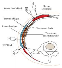 (Oct-2012 Q12) Describe the anatomy of the transversus abdominis plane relevant to regional anaesthesia (70%). List the complications associted with TAP block (30%).