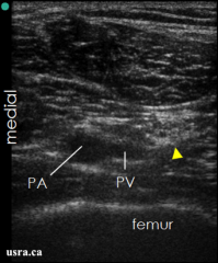 From bottom of u/s screen up (anterior to posterior)
- femur
- popliteal artery and vein (vein is middle), artery is medial, and nerve is lateral - "mickey mouse sign" (vein = head, and others = ears).
- Tibial is medial, and CP is lateral
- medial mu