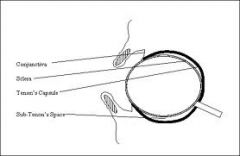 (2010-A) a. Describe the anatomy of the eye relevant to a sub-Tenon’s eye block. (40%) b. Discuss the potential advantages and disadvantages of this technique for providing regional anaesthesia for eye surgery. (60%)