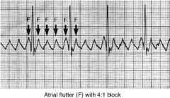 a type of arrhythmia characterized by rapid, but regular, contractions of the atria or ventricles.
