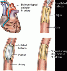 or balloon angioplasty—is a repair procedure (–plasty) in which a balloon-tipped catheter and a mesh-like device called a stent are threaded into a coronary artery to dilate the clogged vessel (angi/o).