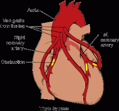 surgical procedure, a blood vessel is grafted onto one of the coronary arteries to bypass the area of occlusion.