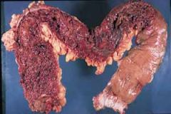 inflammation of the colon