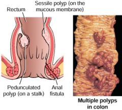 (left picture) an abnormal tube-like passageway near the anus, which often results from an infection