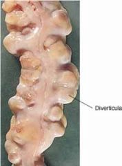 the presence of abnormal sac-like outpouchings in the colon wall,