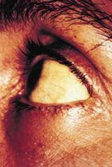 which results when yellow bile pigments accumulate in the blood and are deposited in the skin and eyes