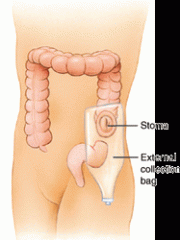 which is an artificial opening (–stomy) into the colon through the abdominal wall, used for the passage of stool, especially in cancer of the colon