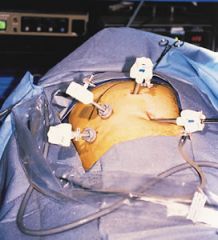 involves gallbladder removal through visual examination of the interior (–scopy) of the abdomen by means of a laparoscope inserted through one or more small incisions in the abdominal wall (lapar/o).