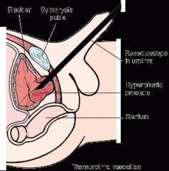 removal of portions of the prostate gland through the urethra.  an electrical hot-loop destroys prostatic tissue, and these portions of the gland are then removed. (procedure is called TURP).  treatment for BHP Benign prostatic hyperplasia (BHP)