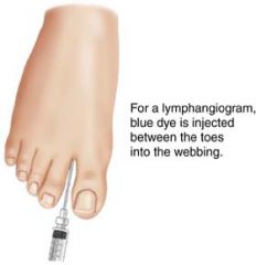 the lymph nodes and lymph vessels (lymphangi/o) are x-rayed after the injection of contrast medium into the lymphatic system.  (injected between the toes in the webbing)