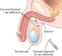 a surgical procedure that produces sterilization by closing off the vas deferens (vas/o) on each side to prevent sperm from being released with semen.