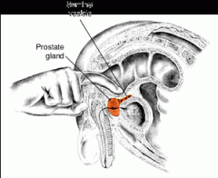 Through the rectal wall, the physician can palpate Frank's prostate for nodules or enlargement.