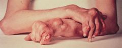 caused by a defect in the metabolism of uric acid, which causes this acid to accumulate in the blood, joints, and soft tissues near the joints.  usually affects the big toe, aggravated by foods rich in uric acid.