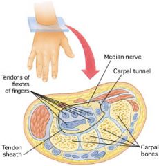 repetitive motion injury.  the median nerve is squeezed or constricted by a wrist (carp/o) ligament as it passes between that ligament and the bones and tendons of the wrist.