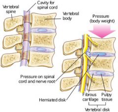 "slipped disk."  caused by the protruding disk's pressure on spinal nerves