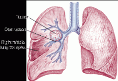 a condition characterized by incomplete expansion or collapse of the alveoli (air sac)