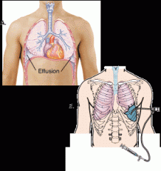 (left image) fluid in the lung