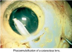 the use of ultrasonic vibration to break up the lens (phac/o) of the eye