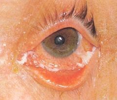an inflammation of the conjunctiva, the mucous membrane lining the inside of the eyelid and sclera.