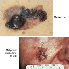 a tumor (–oma), often cancerous, arising from the dark pigment (melan/o = black) in the skin