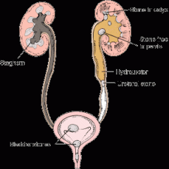 kidney stones.  an abnormal condition (–iasis) referred to as kidney (nephr/o) stones (lith/o)