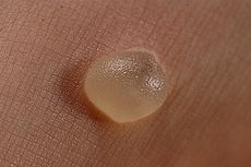 small pocket of fluid within the upper layers of the skin, typically caused by forceful rubbing (friction), burning, freezing, chemical exposure or infection.