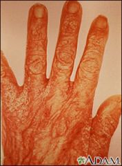 *  contagious skin infection caused by the itch mite Sarcoptes scabiei
*  transmitted during skin to skin contact