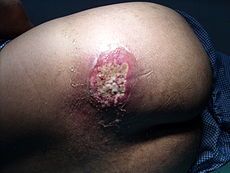 a group of untreated boils may fuse into even larger pus-filled lesion