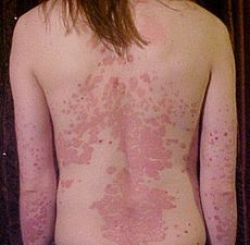 an immune-mediated disease that affects the skin. It is typically a lifelong condition. There is currently no cure, but various treatments can help to control the symptoms.
*characterized by silvery white, scale-like plaques that remain fixed on the skin