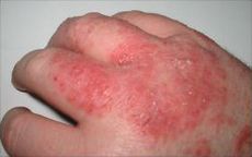 *most common inflammatory condition of the skin
*inflammation accompanied by papules, vesicles, and crusts.
*not a disease rather a sign or symptom of an underlying condition.
ie.  contact dermatitis