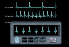 *  a recording of the heart's electrical activity
*  It appears as a graph or series of wave lines on a moving strip of paper and can indicate:

1.  Heart rate and rhythm
2.  Decreased blood flow
3.  Hypertrophy of the heart
4.  Current or past hear