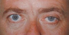 Horner's syndrome is a sympathetic defect

- ptosis (droopy eyelid)
- miosis (constricted pupil)
- anhydrosis (lack of sweating)

One can do a clinical confirmation with cocaine test: cocaine does not dilate a miotic Horner's pupil