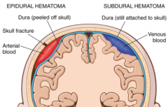 1. Epidural Haematoma
- shearing of arteries causes bleeding in between skull and dura (dura peels off skull)
- build of blood puts pressure on the intracranial space =>brain shift

2. Subdural Haematoma
- tearing of bridging veins in the subdural...